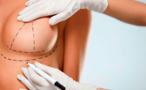 Read more about the article Qual o tamanho dos implantes mamários que devo escolher em um aumento de mama?